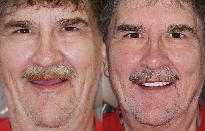 (⏰Limited time discount last 30 minutes⏰)HZA™-🦷Advanced Customized Full Denture Set🦷