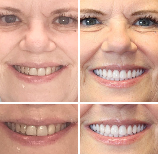 (⏰Limited time discount last 30 minutes⏰)HZA™-🦷Advanced Customized Full Denture Set🦷