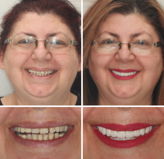 (⏰Limited time discount last 30 minutes⏰)HZA™-🦷Advanced Customized Full Denture Set🦷