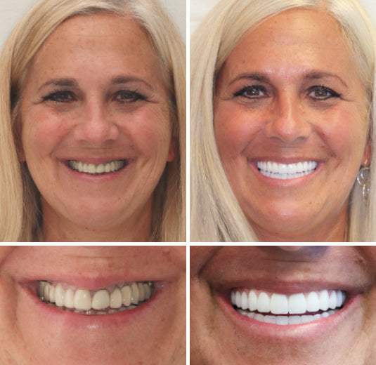 (⏰Limited time discount last 30 minutes⏰)HZA™-🦷Advanced Customized Full Denture Set🦷