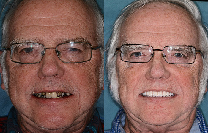 (⏰Limited time discount last 30 minutes⏰)HZA™-🦷Advanced Customized Full Denture Set🦷
